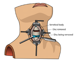 Diagram of anterior cervical discectomy and fusion (ACDF) surgery