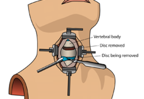 Diagram of ACDF surgery