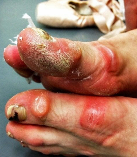 Close-up of a ballerina’s injured feet